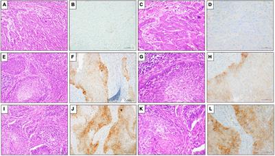 Immunotherapy in Penile Squamous Cell Carcinoma: Present or Future? Multi-Target Analysis of Programmed Cell Death Ligand 1 Expression and Microsatellite Instability